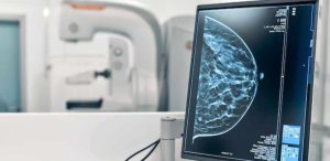 Instantâneo de mamografia digital de seios de uma paciente do sexo feminino no monitor