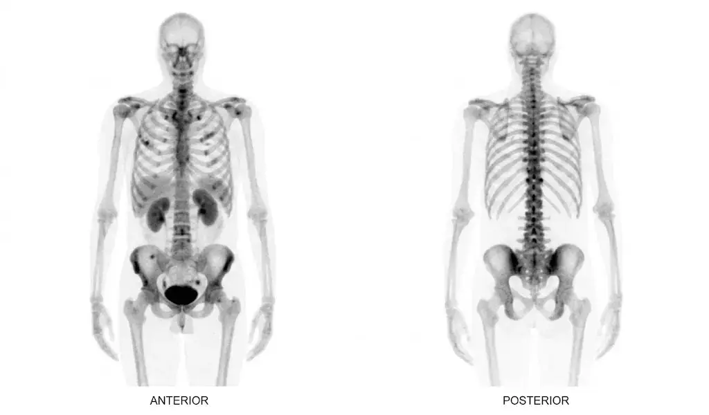 cintilografia óssea